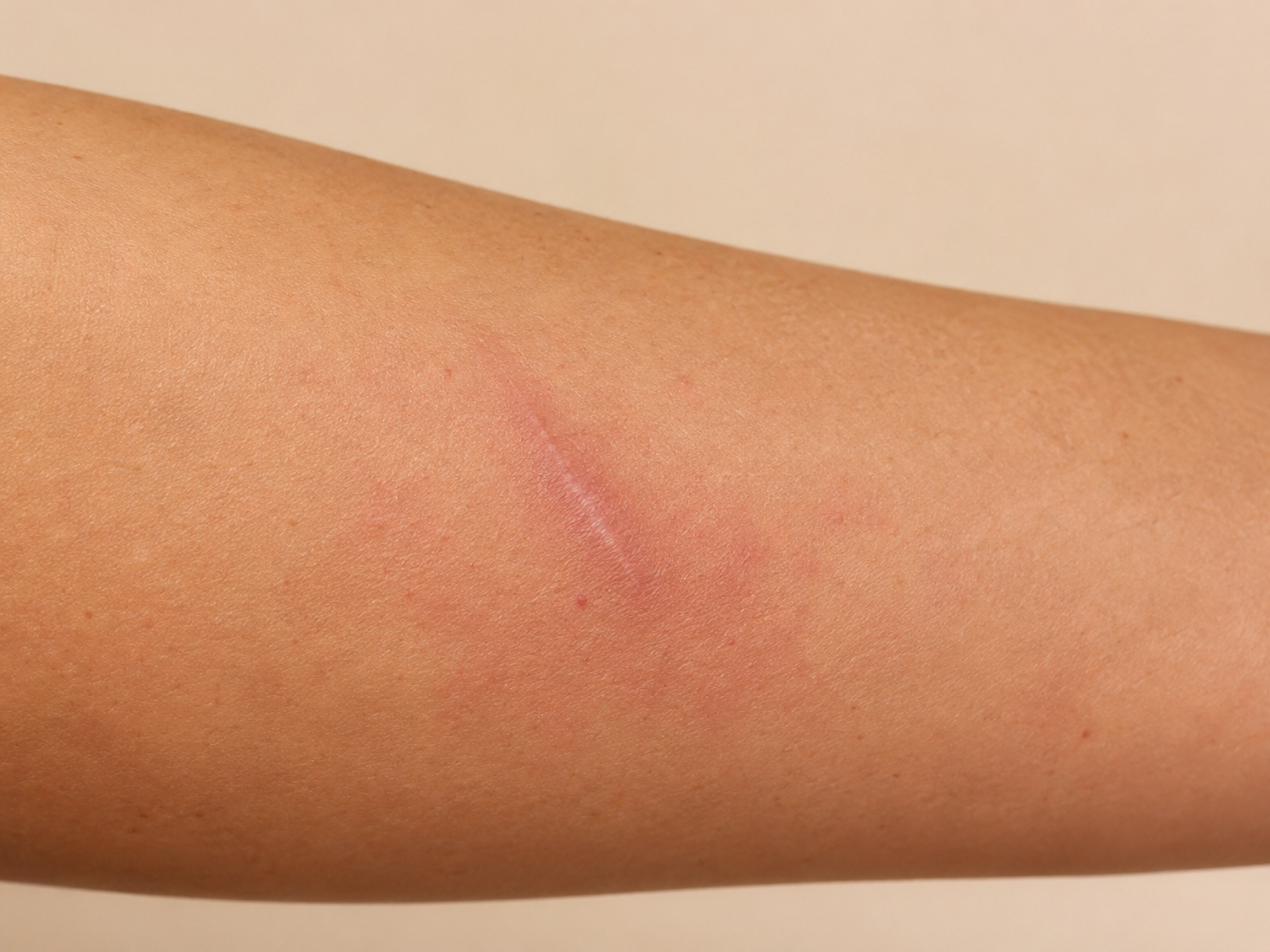 Antes de usar restaurador cutáneo para cicatriz sensibilizada