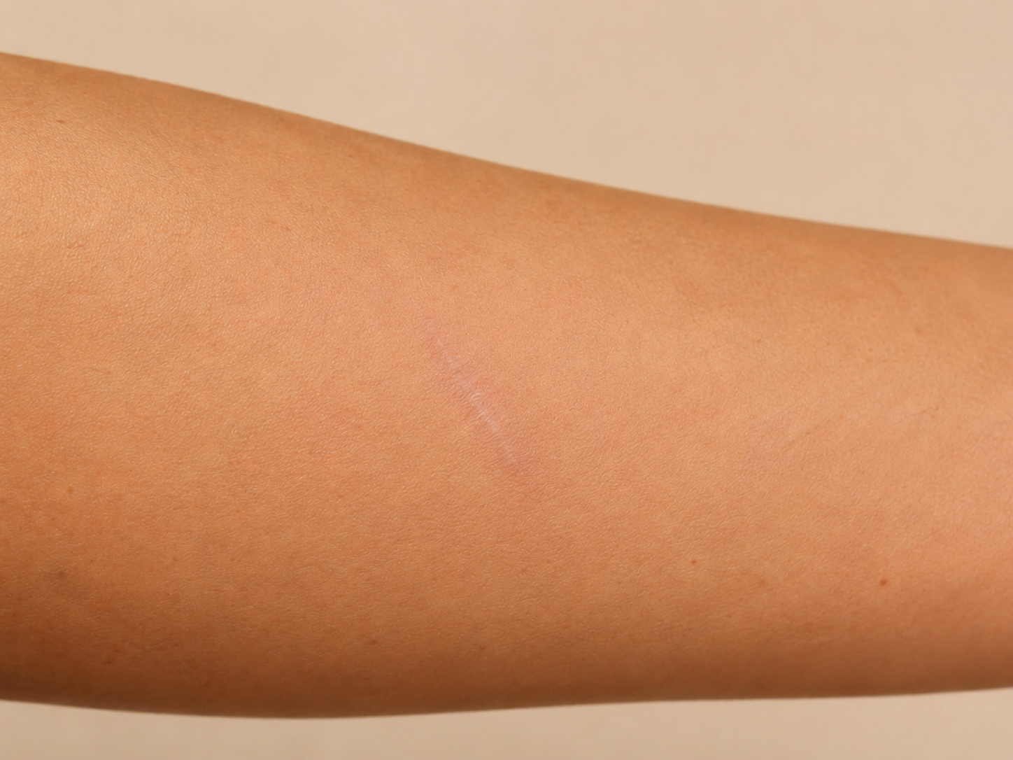 Después de usar restaurador cutáneo para cicatriz sensibilizada