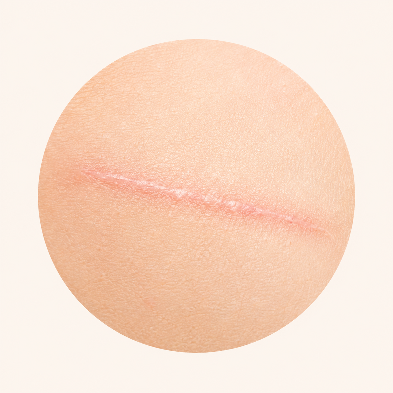 Láminas UltraSkin para cicatrices recientes