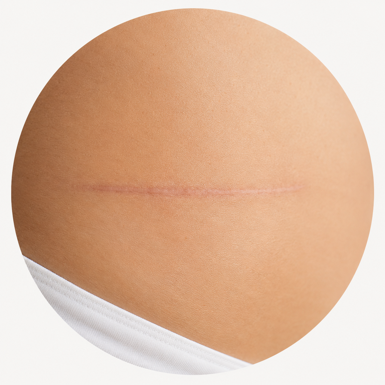 Láminas UltraSkin para cicatrices por cirugía