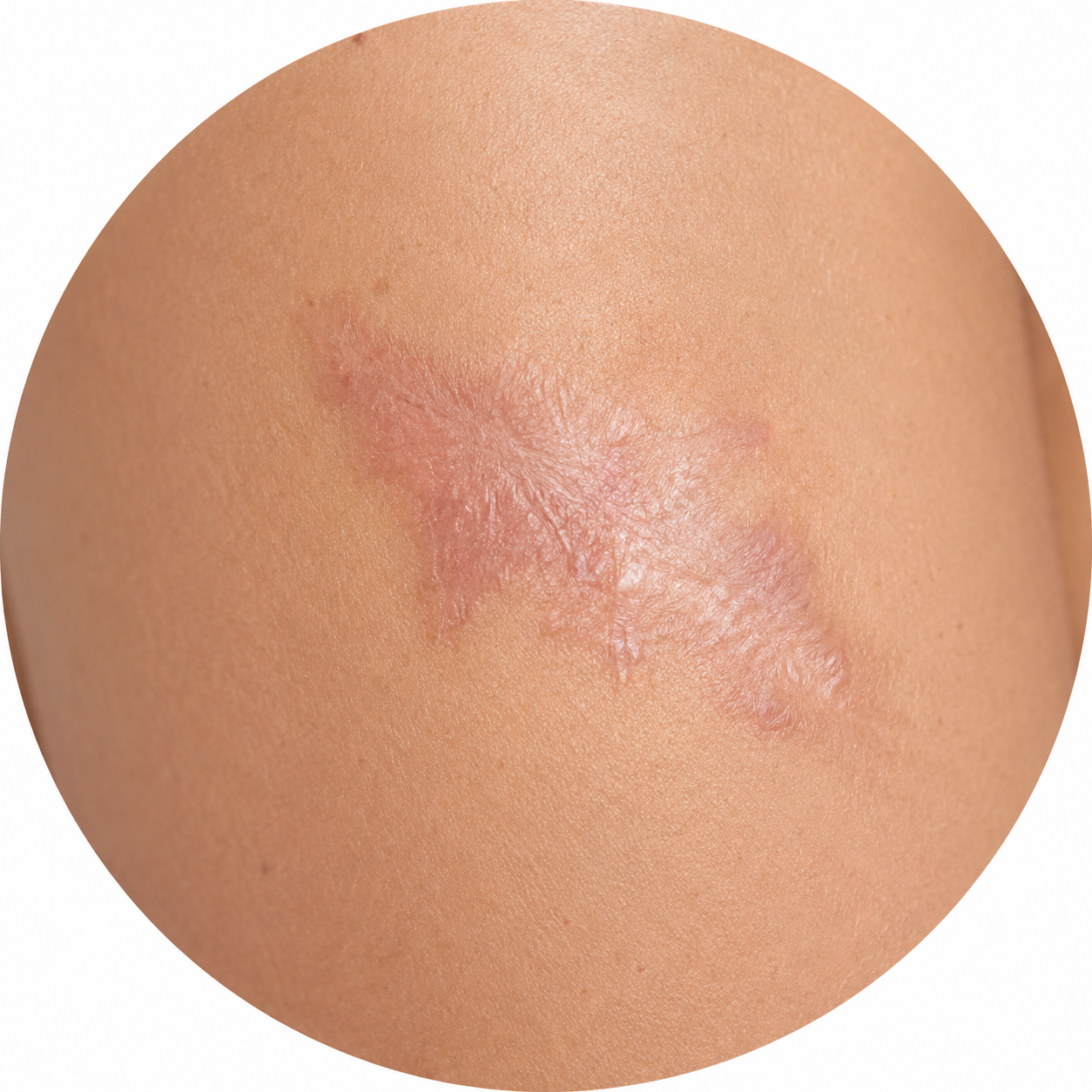 Láminas UltraSkin para cicatrices por quemaduras