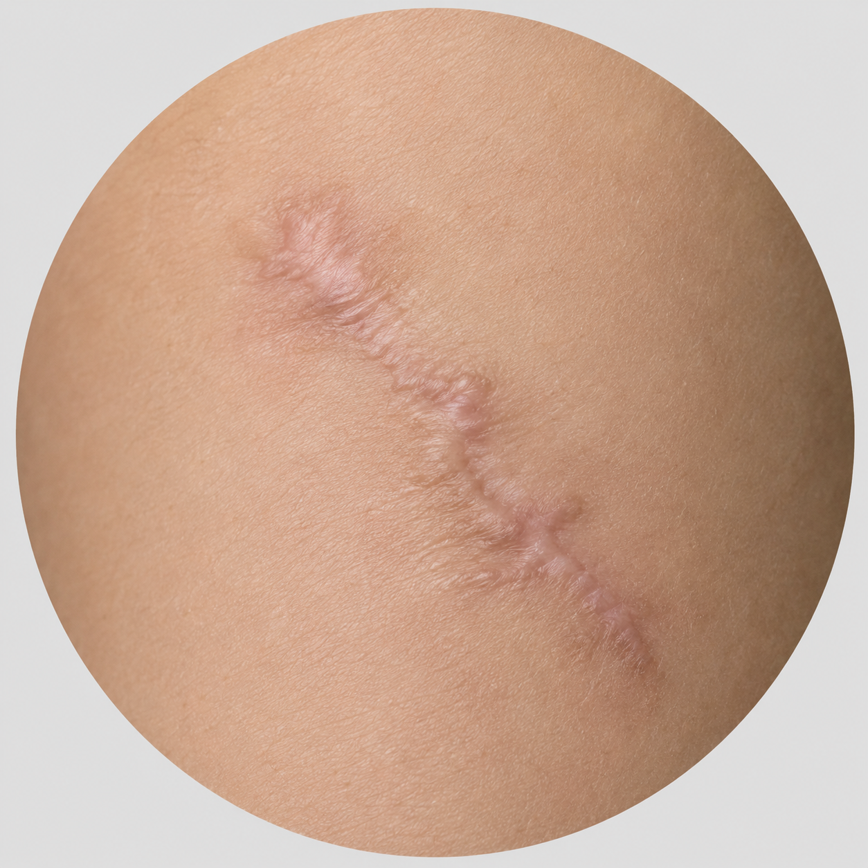 Láminas UltraSkin para cicatrices traumáticas