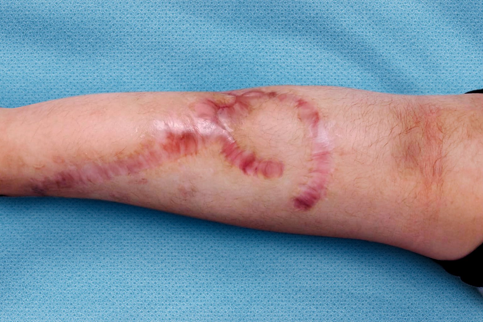 Antes de usar restaurador cutáneo para cicatriz sensibilizada