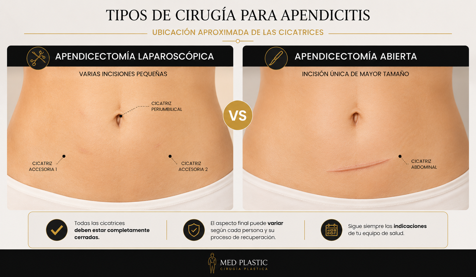 Tipos de cicatriz después de una apendicitis laparoscópica y cirugía abierta