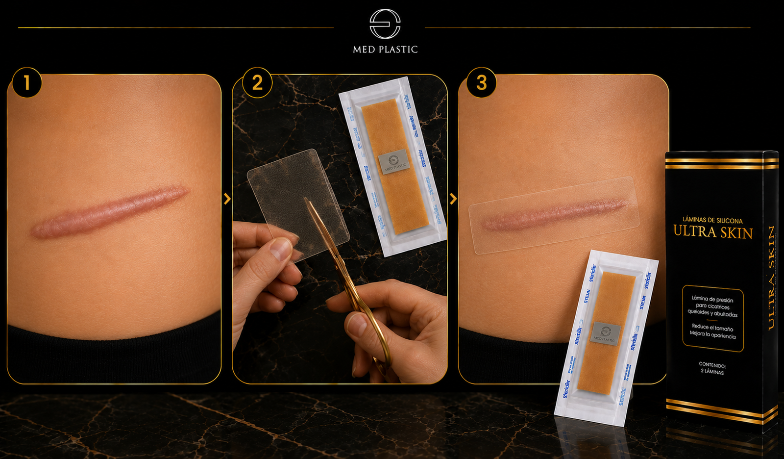 Cómo usar UltraSkin en una cicatriz hipertrófica completamente cerrada