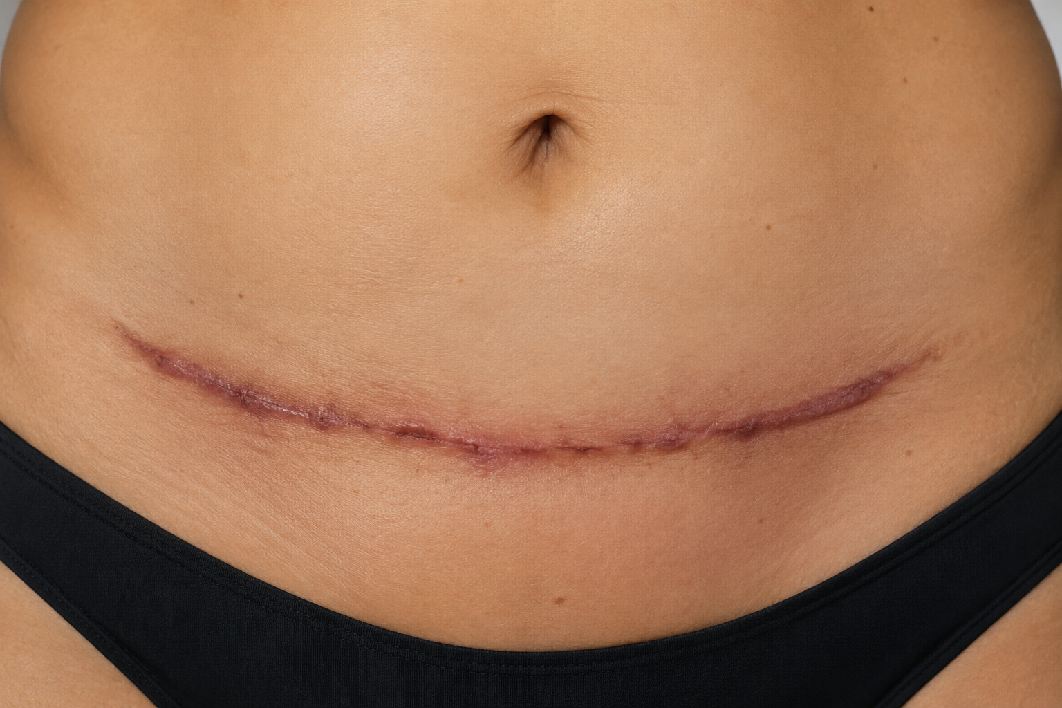Resultado después del cuidado de una cicatriz de abdominoplastia