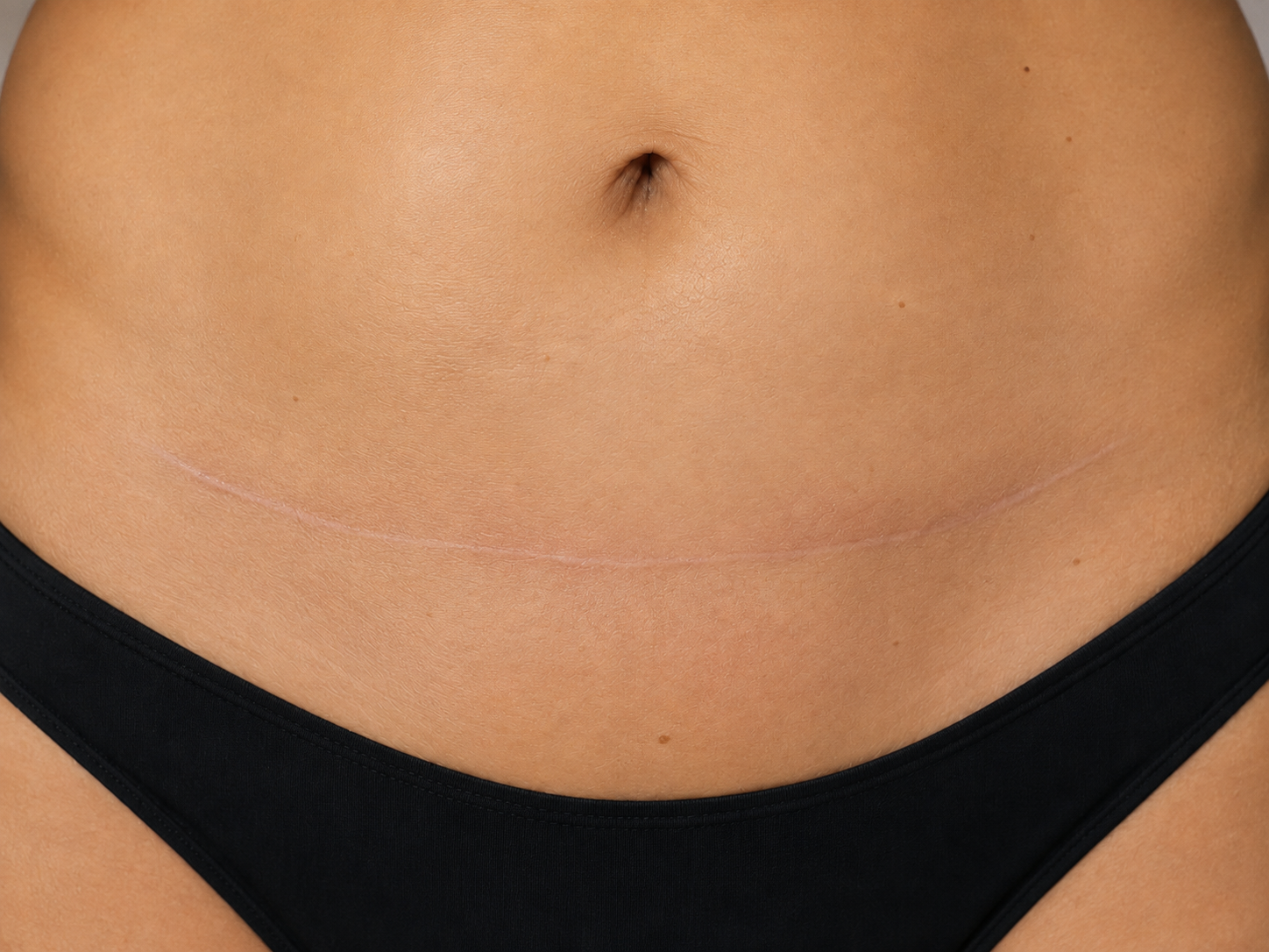 Estado anterior de una cicatriz de abdominoplastia