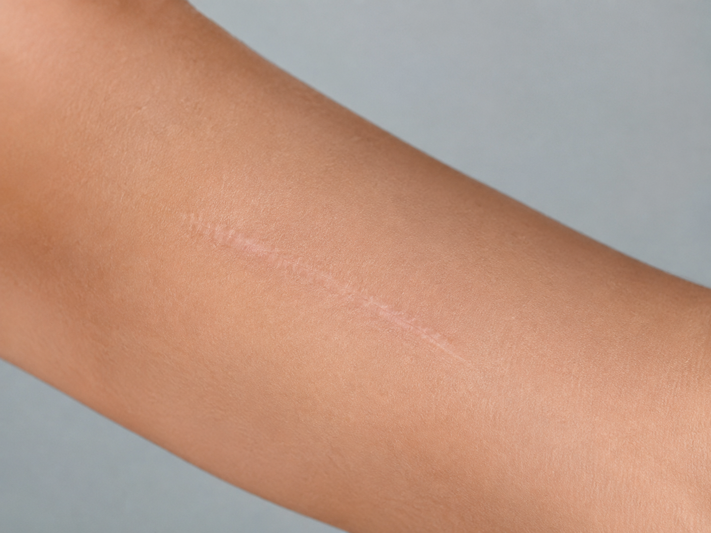 Estado anterior de una cicatriz hipertrófica en el brazo