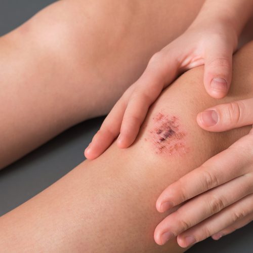 Injured leg wound knee with blood and doctor's hands in blue medical gloves treats a patient, treats a wound