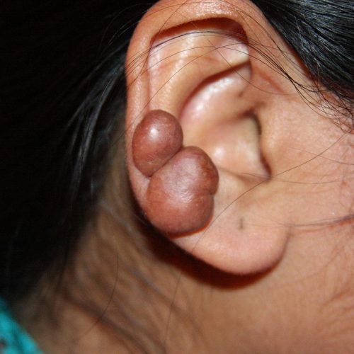 queloide-oreja.jpg