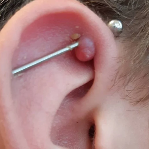 queloide piercing